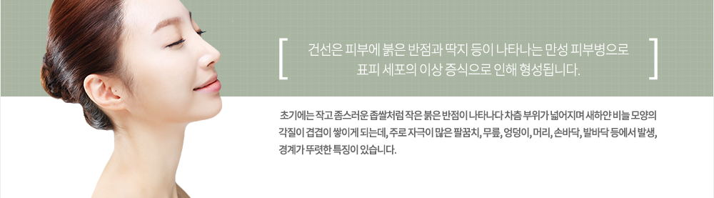 건선은 피부에 붉은 반점과 딱지 등이 나타나는 만성 피부병으로 표피 세포의 이상 증식으로 인해 형성됩니다. 초기에는 작고 좀스러운 좁쌀처럼 작은 붉은 반점이 나타나다 차츰 부위가 넓어지며 새하얀 비늘 모양의 각질이 겹겹이 쌓이게 되는데, 주로 자극이 많은 팔꿈치, 무릎, 엉덩이, 머리, 손바닥, 발바닥 등에서 발생, 경계가 뚜렷한 특징이 있습니다.
