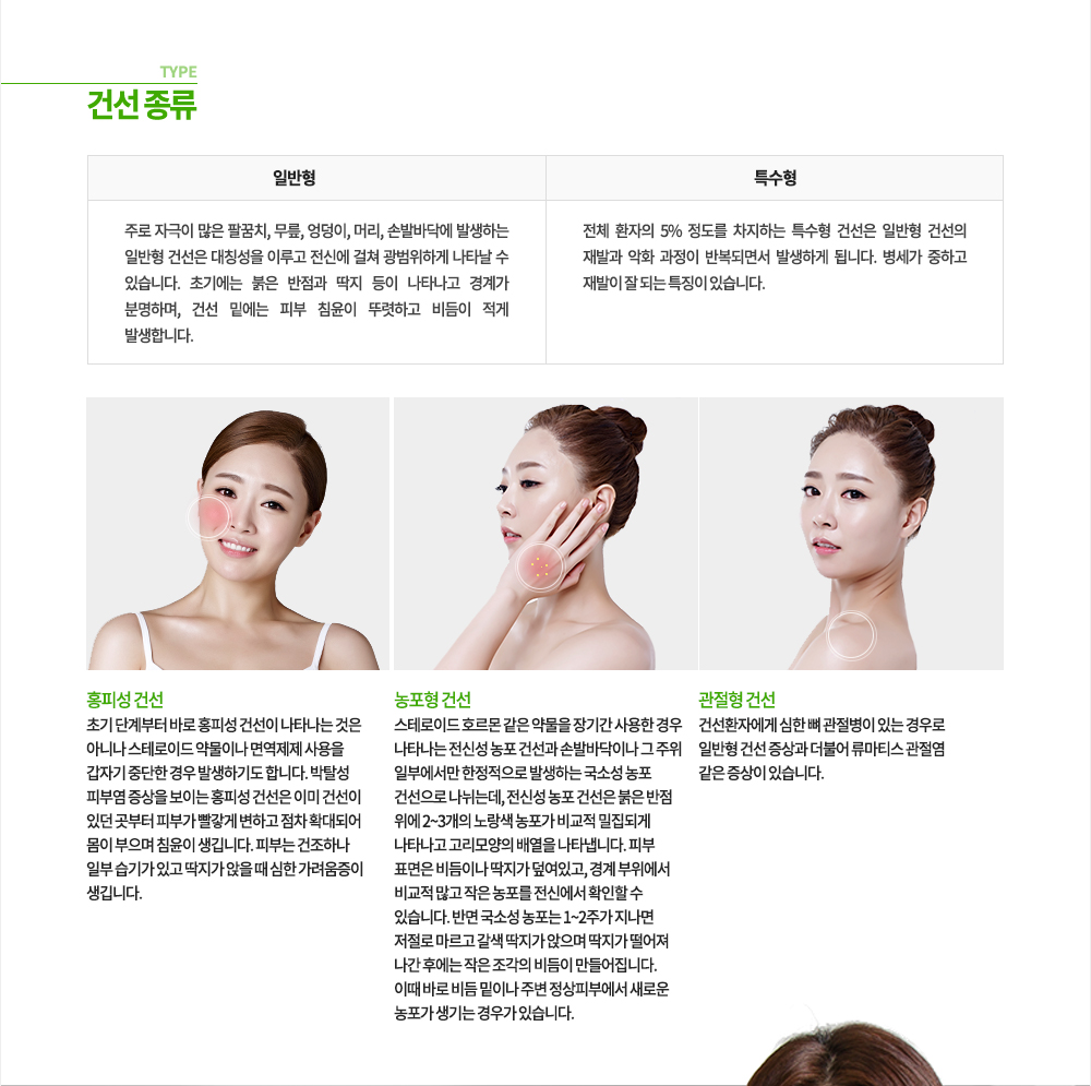 건선 종류
-일반형
주로 자극이 많은 팔꿈치, 무릎, 엉덩이, 머리, 손발바닥에 발생하는 일반형 건선은 대칭성을 이루고 전신에 걸쳐 광범위하게 나타날 수 있습니다. 초기에는 붉은 반점과 딱지 등이 나타나고 경계가 분명하며, 건선 밑에는 피부 침윤이 뚜렷하고 비듬이 적게 발생합니다.
-특수형
전체 환자의 5% 정도를 차지하는 특수형 건선은 일반형 건선의 재발과 악화 과정이 반복되면서 발생하게 됩니다. 병세가 중하고 재발이 잘 되는 특징이 있습니다.
1. 관절형 건선 : 건선환자에게 심한 뼈 관절병이 있는 경우로 일반형 건선 증상과 더불어 류마티스 관절염 같은 증상이 있습니다.
2. 농포형 건선 : 스테로이드 호르몬 같은 약물을 장기간 사용한 경우 나타나는 전신성 농포 건선과 손발바닥이나 그 주위 일부에서만 한정적으로 발생하는 국소성 농포 건선으로 나뉘는데, 전신성 농포 건선은 붉은 반점 위에 2~3개의 노랑색 농포가 비교적 밀집되게 나타나고 고리모양의 배열을 나타냅니다. 피부 표면은 비듬이나 딱지가 덮어있고, 경계 부위에서 비교적 많고 작은 농포를 전신에서 확인할 수 있습니다. 반면 국소성 농포는 1~2주가 지나면 저절로 마르고 갈색 딱지가 앉으며 딱지가 떨어져 나간 후에는 작은 조각의 비듬이 만들어집니다. 이때 바로 비듬 밑이나 주변 정상피부에서 새로운 농포가 생기는 경우가 있습니다.
3. 홍피성 건선 : 초기 단계부터 바로 홍피성 건선이 나타나는 것은 아니나 스테로이드 약물이나 면역제제 사용을 갑자기 중단한 경우 발생하기도 합니다. 박탈성 피부염 증상을 보이는 홍피성 건선은 이미 건선이 있던 곳부터 피부가 빨갛게 변하고 점차 확대되어 몸이 부으며 침윤이 생깁니다. 피부는 건조하나 일부 습기가 있고 딱지가 앉을 때 심한 가려움증이 생깁니다.
