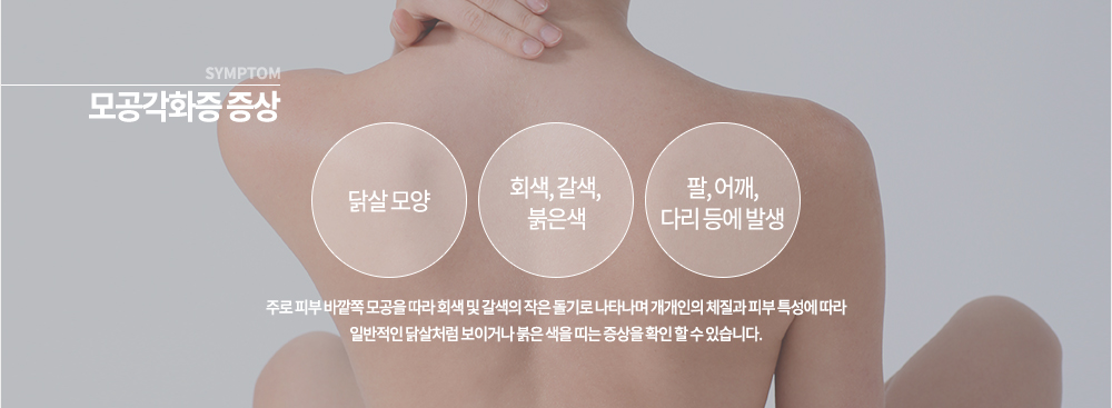 모공각화증 증상
▶ 팔, 어깨, 다리
주로 피부 바깥쪽 모공을 따라 회색 및 갈색의 작을 돌기로 나타나며 개개인의 체질과 피부 특성에 따라 일반적인 닭살처럼 보이거나 붉은 색을 띠는 증상을 확인 할 수 있습니다.

