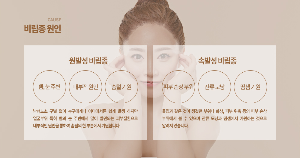 비립종 원인 ▶ 원발성 비립종
남녀노소 구별 없이 누구에게나 어디에서든 쉽게 발생 하지만 얼굴부위 특히 뺨과 눈 주변에서 많이 발견되는 피부질환으로 내부적인 원인을 통하여 솜털의 한 부분에서 기원합니다.
▶ 속발성 비립종
물집과 같은 것이 생겼던 부위나 화상, 피부 위축 등의 피부 손상 부위에서 볼 수 있으며 잔류 모낭과 땀샘에서 기원하는 것으로 알려져 있습니다.
