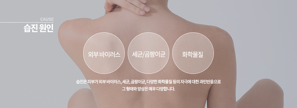 ♧ 습진 원인	
습진은 피부가 외부 바이러스, 세균, 곰팡이균, 다양한 화학물질 등의 자극에 대한 과민반응으로 그 형태와 양상은 매우 다양합니다.

