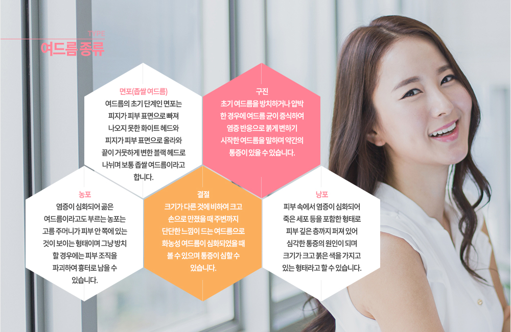 여드름 종류
-면포(좁쌀 여드름)
여드름의 초기 단계인 면포는 피지가 피부 표면으로 빠져 나오지 못한 화이트 헤드와 피지가 피부 표면으로 올라와 끝이 거뭇하게 변한 블랙 헤드로 나뉘며 보통 좁쌀 여드름이라고 합니다.
-구진
초기 여드름을 방치하거나 압박 한 경우에 여드름 균이 증식하여 염증 반응으로 붉게 변하기 시작한 여드름을 말하며 약간의 통증이 있을 수 있습니다.
-농포
염증이 심화되어 곪은 여드름이라고도 부르는 농포는 고름 주머니가 피부 안 쪽에 있는 것이 보이는 형태이며 그냥 방치 할 경우에는 피부 조직을 파괴하여 흉터로 남을 수 있습니다.
-결절
크기가 다른 것에 비하여 크고 손으로 만졌을 때 주변까지 단단한 느낌이 드는 여드름으로 화농성 여드름이 심화되었을 때 볼 수 있으며 통증이 심할 수 있습니다.
-낭포
피부 속에서 염증이 심화되어 죽은 세포 등을 포함한 형태로 피부 깊은 층까지 퍼져 있어 심각한 통증의 원인이 되며 크기가 크고 붉은 색을 가지고 있는 형태라고 할 수 있습니다.
