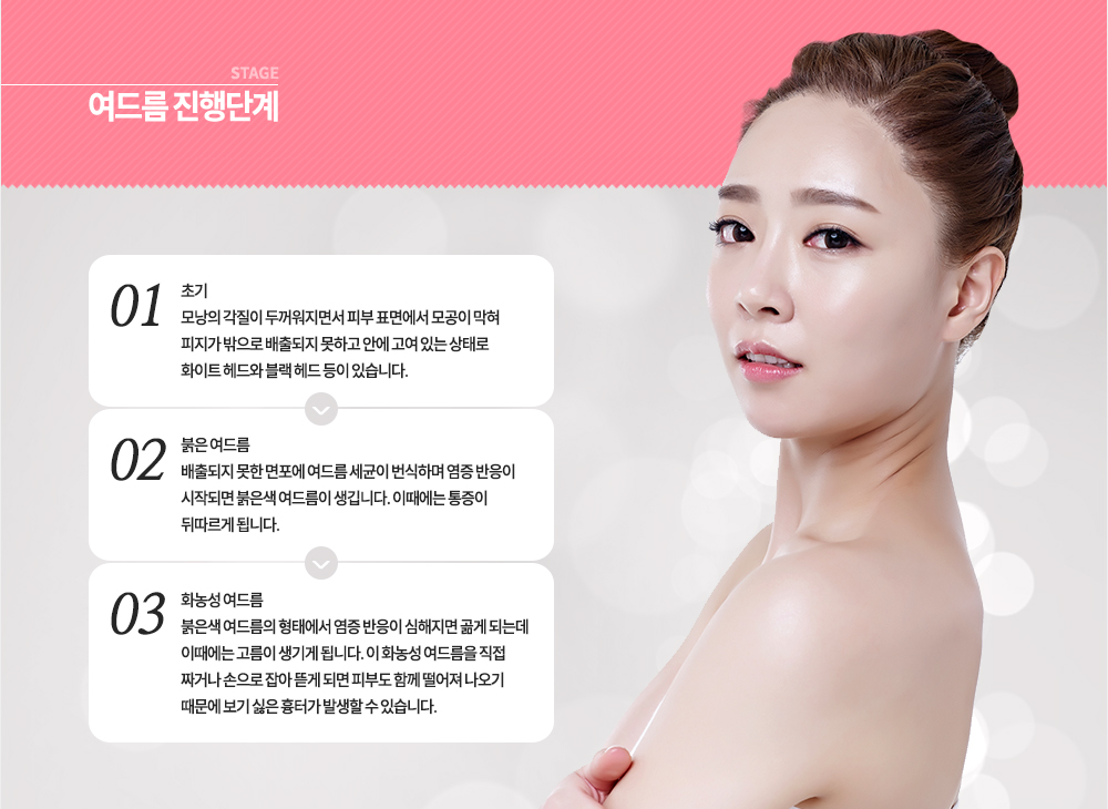 여드름 진행단계
-초기 : 모낭의 각질이 두꺼워지면서 피부 표면에서 모공이 막혀 피지가 밖으로 배출되지 못하고 안에 고여 있는 상태로 화이트 헤드와 블랙 헤드 등이 있습니다.
-붉은 여드름 : 배출되지 못한 면포에 여드름 세균이 번식하며 염증 반응이 시작되면 붉은색 여드름이 생깁니다. 이때에는 통증이 뒤따르게 됩니다.
-화농성 여드름 : 붉은색 여드름의 형태에서 염증 반응이 심해지면 곪게 되는데 이때에는 고름이 생기게 됩니다. 이 화농성 여드름을 직접 짜거나 손으로 잡아 뜯게 되면 피부도 함께 떨어져 나오기 때문에 보기 싫은 흉터가 발생할 수 있습니다.

 