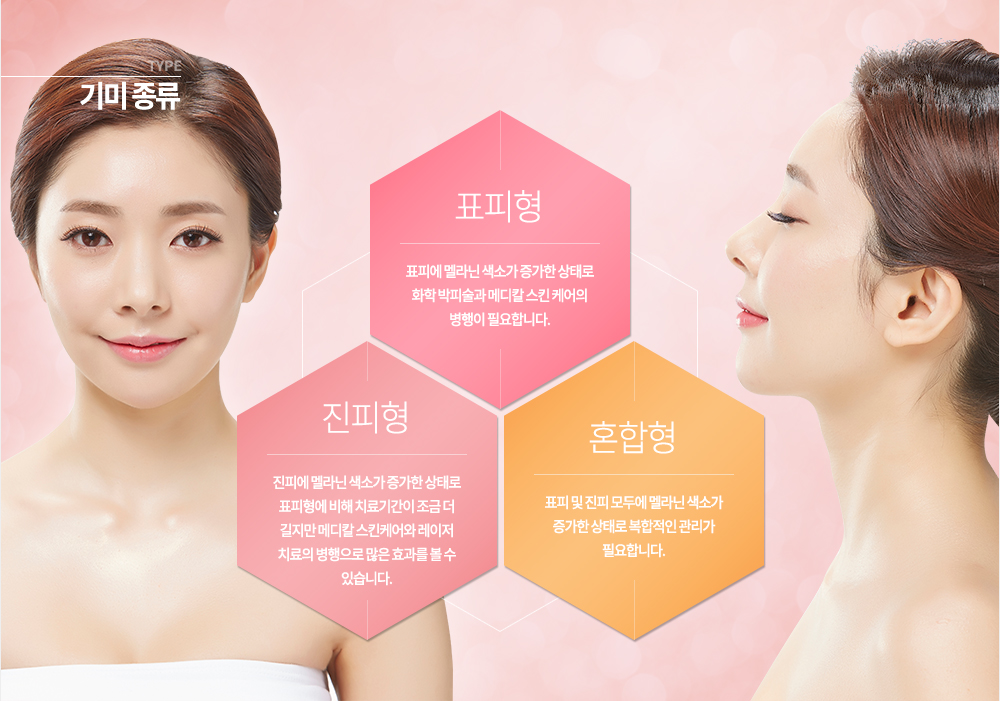 기미 종류
1. 표피형 : 표피에 멜라닌 색소가 증가한 상태로 화학 박피술과 메디칼 스킨 케어의 병행이 필요합니다.
2. 진피형 : 진피에 멜라닌 색소가 증가한 상태로 표피형에 비해 치료기간이 조금 더 길지만 메디칼 스킨케어와 레이저 치료의 병행으로 많은 효과를 볼 수 있습니다.
3. 혼합형 : 표피 및 진피 모두에 멜라닌 색소가 증가한 상태로 복합적인 관리가 필요합니다.
