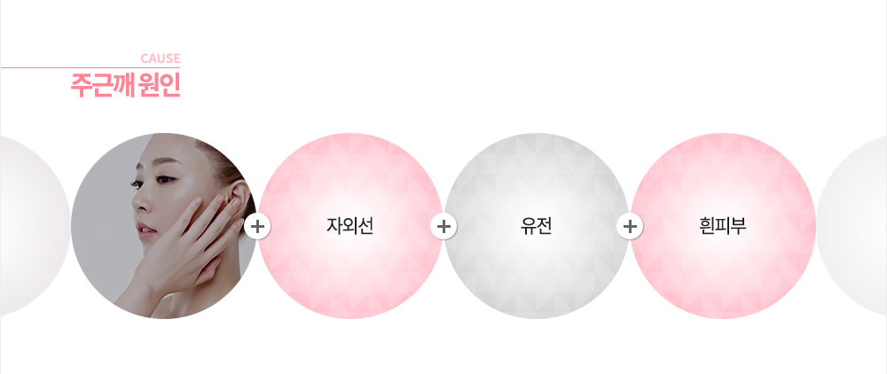 원인
유전
자외선
흰피부
